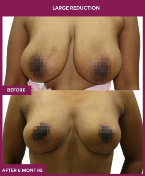 large-breast-reduction-surgery-before-after-results-mumbai-india-patient05-front