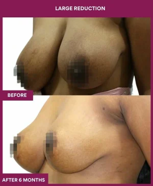 large-breast-reduction-surgery-before-after-results-mumbai-india-patient05-side-left