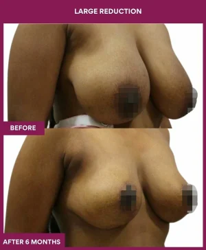 large-breast-reduction-surgery-before-after-results-mumbai-india-patient05-side-right