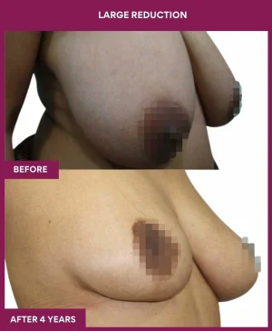 large-breast-reduction-surgery-before-after-results-mumbai-india-patient06-side-right