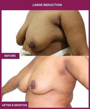 large-breast-reduction-surgery-before-after-results-mumbai-india-patient07-side-left