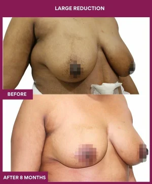 large-breast-reduction-surgery-before-after-results-mumbai-india-patient07-side-right