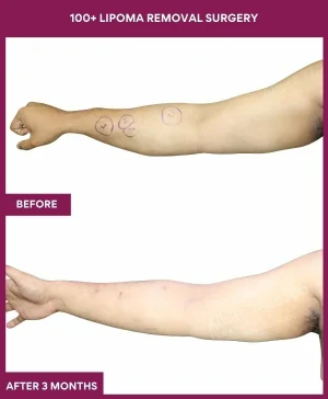 lipoma-removal-arm-before-after-results-mumbai-india-patient01-side-left