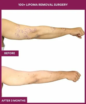 lipoma-removal-arm-before-after-results-mumbai-india-patient01-side-right