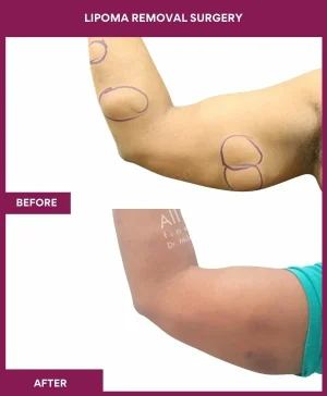 lipoma-removal-arm-before-after-results-mumbai-india-patient09-side-left