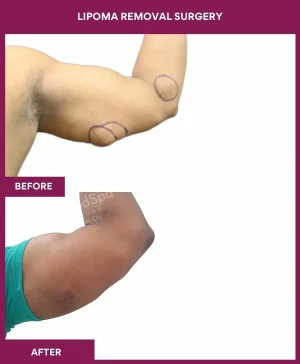 lipoma-removal-arm-before-after-results-mumbai-india-patient09-side-right