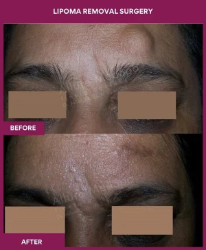 lipoma-removal-forehead-before-after-results-mumbai-india-patient13-close-up