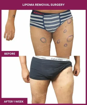 lipoma-removal-leg-back-before-after-results-mumbai-india-patient08-front
