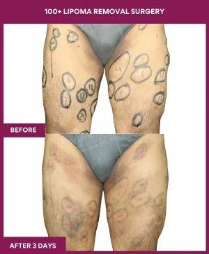 lipoma-removal-leg-before-after-results-mumbai-india-patient03-front