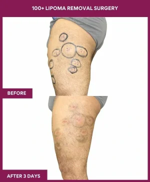 lipoma-removal-leg-before-after-results-mumbai-india-patient03-side-left