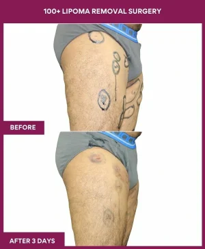 lipoma-removal-leg-before-after-results-mumbai-india-patient03-side-right