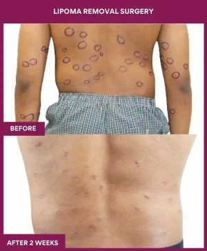 lipoma-removal-leg-before-after-results-mumbai-india-patient04-back