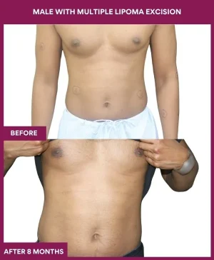lipoma-removal-stomatch-before-after-results-mumbai-india-patient11-abdomen