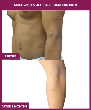 lipoma-removal-stomatch-before-after-results-mumbai-india-patient11-left-hand