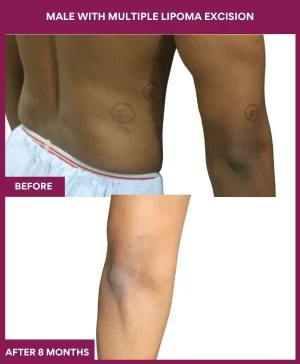 lipoma-removal-stomatch-before-after-results-mumbai-india-patient11-right-hand