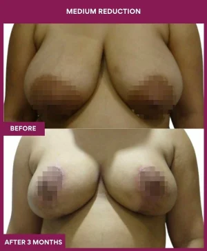 medium-breast-reduction-surgery-before-after-results-mumbai-india-patient01-front