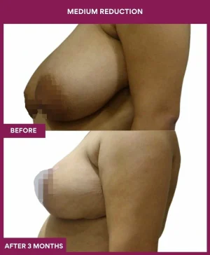 medium-breast-reduction-surgery-before-after-results-mumbai-india-patient01-side-left