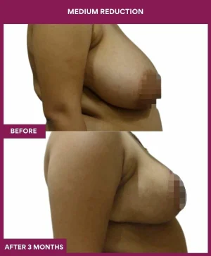 medium-breast-reduction-surgery-before-after-results-mumbai-india-patient01-side-right
