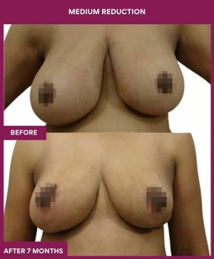 medium-breast-reduction-surgery-before-after-results-mumbai-india-patient02-front