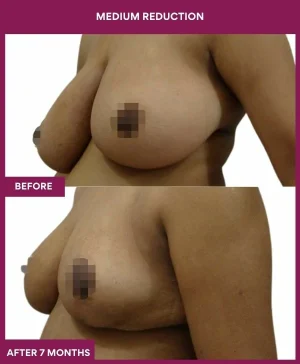 medium-breast-reduction-surgery-before-after-results-mumbai-india-patient02-side-left