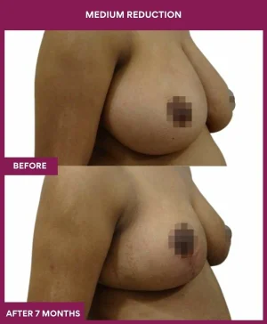 medium-breast-reduction-surgery-before-after-results-mumbai-india-patient02-side-right