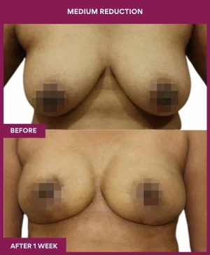 medium-breast-reduction-surgery-before-after-results-mumbai-india-patient03-front