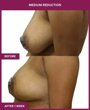 medium-breast-reduction-surgery-before-after-results-mumbai-india-patient03-side-left