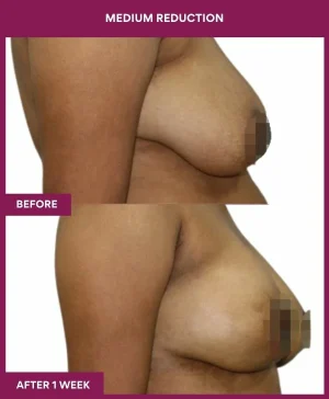medium-breast-reduction-surgery-before-after-results-mumbai-india-patient03-side-right