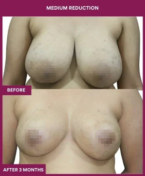 medium-breast-reduction-surgery-before-after-results-mumbai-india-patient04-front