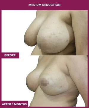 medium-breast-reduction-surgery-before-after-results-mumbai-india-patient04-side-left