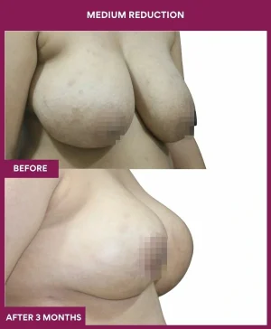 medium-breast-reduction-surgery-before-after-results-mumbai-india-patient04-side-right