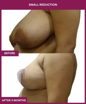 small-breast-reduction-surgery-before-after-results-mumbai-india-patient02-side-left