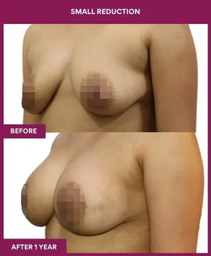 small-breast-reduction-surgery-before-after-results-mumbai-india-patient03-side-left