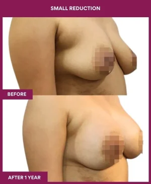 small-breast-reduction-surgery-before-after-results-mumbai-india-patient03-side-right