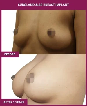 subglandular-breast-augmentation-before-after-results-mumbai-india-patient01-front-left