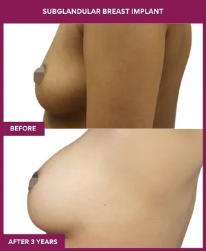 subglandular-breast-augmentation-before-after-results-mumbai-india-patient01-side-left