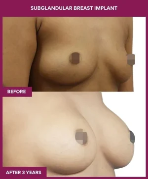 subglandular-breast-augmentation-before-after-results-mumbai-india-patient01-side-right