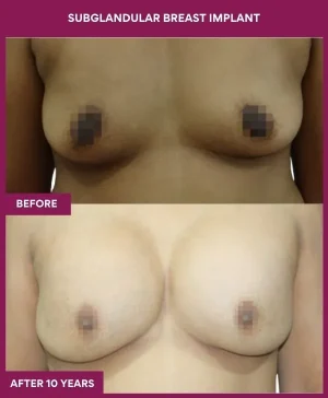subglandular-breast-augmentation-before-after-results-mumbai-india-patient02-front