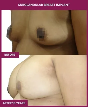 subglandular-breast-augmentation-before-after-results-mumbai-india-patient02-side-left