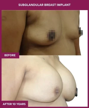 subglandular-breast-augmentation-before-after-results-mumbai-india-patient02-side-right