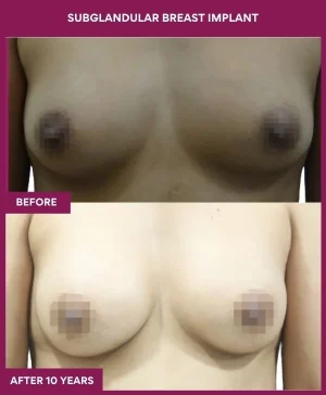 subglandular-breast-augmentation-before-after-results-mumbai-india-patient03-front