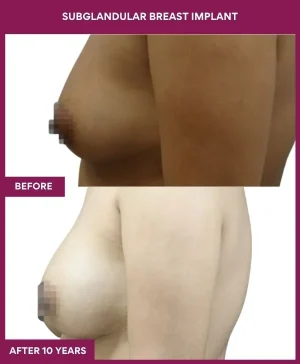 subglandular-breast-augmentation-before-after-results-mumbai-india-patient03-side-left