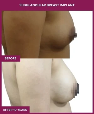 subglandular-breast-augmentation-before-after-results-mumbai-india-patient03-side-right