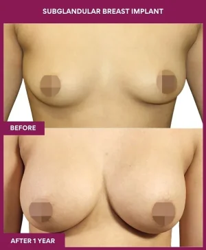 subglandular-breast-augmentation-before-after-results-mumbai-india-patient04-front