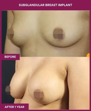 subglandular-breast-augmentation-before-after-results-mumbai-india-patient04-side-left