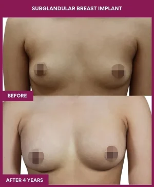 subglandular-breast-augmentation-before-after-results-mumbai-india-patient05-front