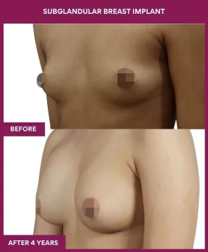 subglandular-breast-augmentation-before-after-results-mumbai-india-patient05-side-left