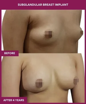 subglandular-breast-augmentation-before-after-results-mumbai-india-patient05-side-right
