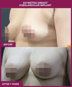 subglandular-breast-augmentation-before-after-results-mumbai-indiapatient06-side-left