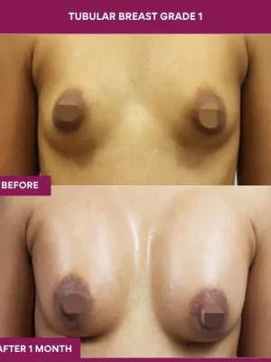 tubular-breast-correction-before-after-results-mumbai-india-patient01-front